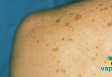 მიზეზი იმისა, თუ რატო ჩნდება მზის ლაქები – ეს უნდა იცოდეთ!