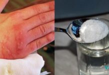 უმკურნალეთ დამწვრობას სუფრის მარილის დახმარებით ! ! მარტივი და ეფექტური მეთოდი..