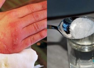 უმკურნალეთ დამწვრობას სუფრის მარილის დახმარებით ! ! მარტივი და ეფექტური მეთოდი..