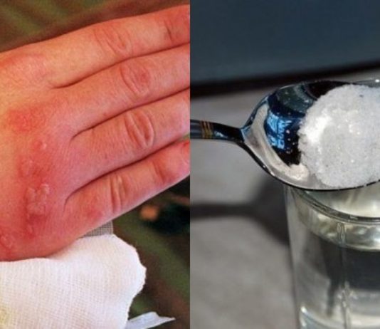 უმკურნალეთ დამწვრობას სუფრის მარილის დახმარებით ! ! მარტივი და ეფექტური მეთოდი..