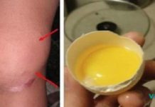 თუ მუხლებში სითხე გიგროვდებათ, მაშინ სცადეთ ეს გამოცდილი რეცეპტი და შედეგი გაგაოცებთ!