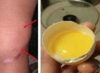 თუ მუხლებში სითხე გიგროვდებათ, მაშინ სცადეთ ეს გამოცდილი რეცეპტი და შედეგი გაგაოცებთ!