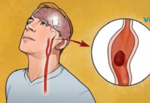 როგორ გავიგოთ, გაქვთ თუ არა ინსულტი? ამ ინფორმაციას შეუძლია გადაარჩინოს თქვენი სიცოცხლე!!!