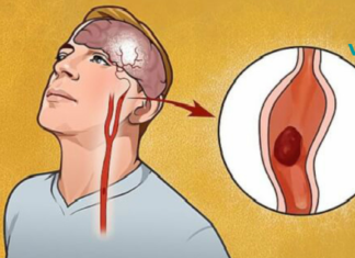 როგორ გავიგოთ, გაქვთ თუ არა ინსულტი? ამ ინფორმაციას შეუძლია გადაარჩინოს თქვენი სიცოცხლე!!!