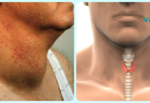 როგორ მოვიშოროთ სწრაფად ფარისებრი ჯირკვლის პრობლემები! ბუნებრივი და ეფექტური გზა!