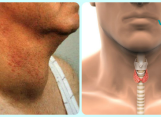 როგორ მოვიშოროთ სწრაფად ფარისებრი ჯირკვლის პრობლემები! ბუნებრივი და ეფექტური გზა!