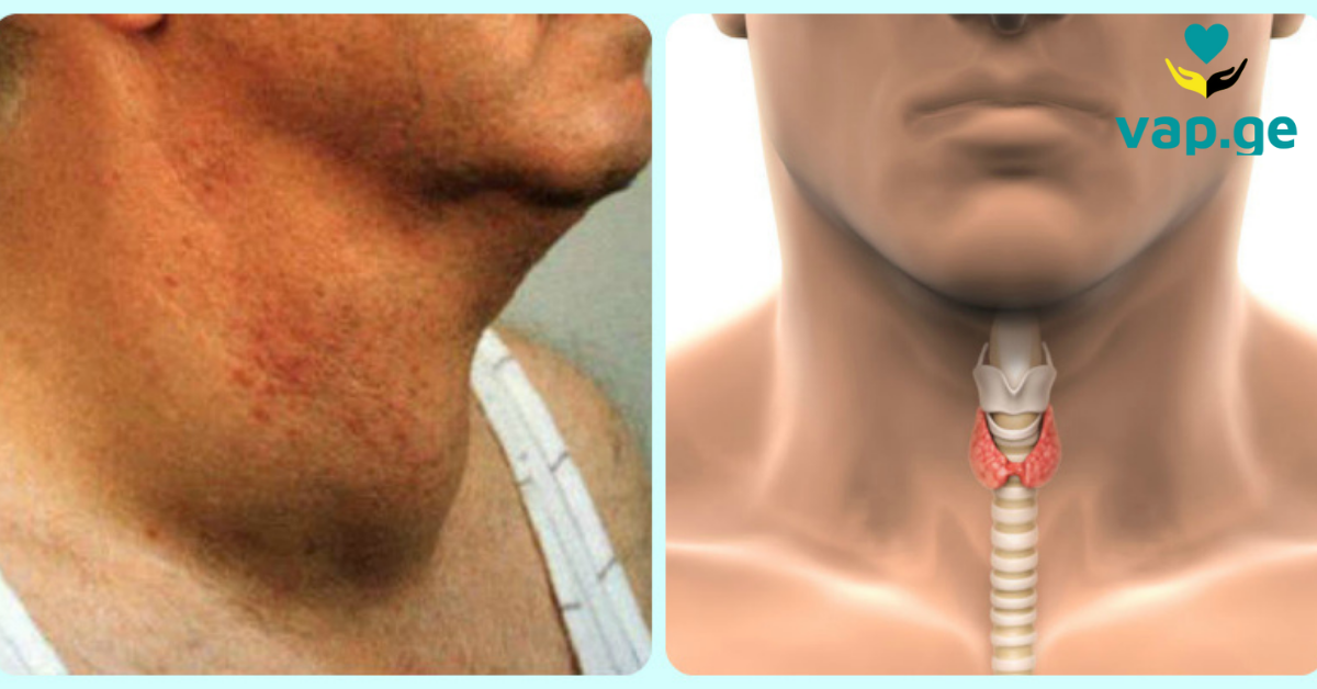 Кадык что это. Аутоиммунный тиреоидит зоб. Кадык и щитовидная железа. Припухлость щитовидки. Щитовидная железа у мужчин.