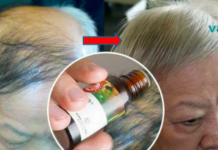 ამ ზეთის 5 წვეთის გამოყენებით 1 თვეში თავს დააღწევთ გამელოტებას და აღადგენთ თმის ზრდას!!