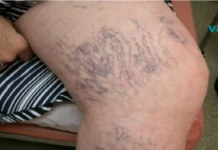 სასწაულებრივი საშუალება, რომელიც ყველას მოგვეპოვება სახლში და რომლითაც შეგიძლიათ ვარიკოზული ვენების მკურნალობა!..