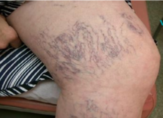 სასწაულებრივი საშუალება, რომელიც ყველას მოგვეპოვება სახლში და რომლითაც შეგიძლიათ ვარიკოზული ვენების მკურნალობა!..