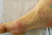 დიაბეტის 10 ნიშანი, რომელიც ყველამ უნდა იცოდეს, ნუ უგულებელყოფთ მათ!