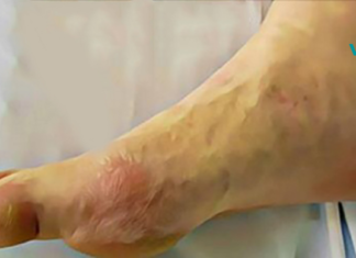 დიაბეტის 10 ნიშანი, რომელიც ყველამ უნდა იცოდეს, ნუ უგულებელყოფთ მათ!