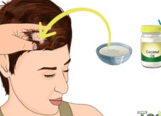 როგორ ვუმკურნალოთ თავის წყლულს? აქ აღმოაჩენთ ისეთ რამეს, რაც ნამდვილად გამოგადგებათ!