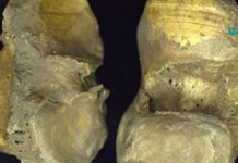 ოსტეოართრიტი არ არის დაკავშირებული დაბერებასთან ის დაკავშირებულია ცხოვრების აქტიურ წესთან! შეიტყვეთ მეტი თქვენი ძვლების სიჯანსაღეზე..