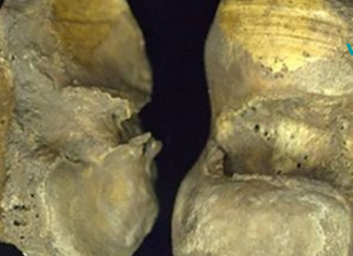 ოსტეოართრიტი არ არის დაკავშირებული დაბერებასთან ის დაკავშირებულია ცხოვრების აქტიურ წესთან! შეიტყვეთ მეტი თქვენი ძვლების სიჯანსაღეზე..