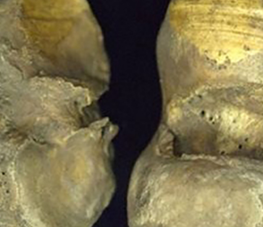 ოსტეოართრიტი არ არის დაკავშირებული დაბერებასთან ის დაკავშირებულია ცხოვრების აქტიურ წესთან! შეიტყვეთ მეტი თქვენი ძვლების სიჯანსაღეზე..