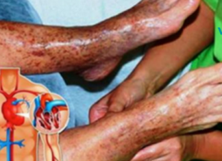 ფანტასტიკური ხალხური რეცეპტი, რომელიც ხსნის კლომებს: ვარიკოზული ვენებით დაავადებული ადამიანების ხსნა!