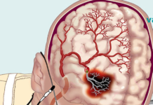 როგორ გავაუმჯობესოთ ცერებრალური მიმოქცევა ხალხური საშუალებების დახმარებით?