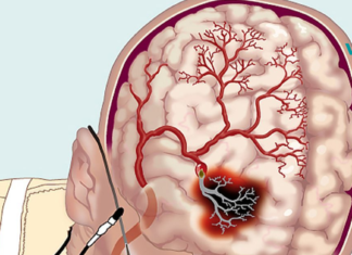 როგორ გავაუმჯობესოთ ცერებრალური მიმოქცევა ხალხური საშუალებების დახმარებით?