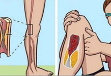 7 გამაფრთხილებელი ნიშანი, რომ დაბინდული გაქვთ არტერიები!