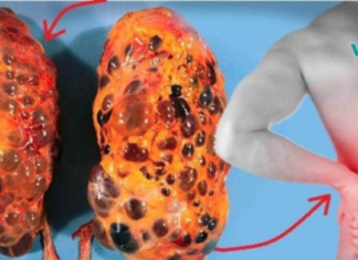 წარმოგიდგენთ 8 მავნე ჩვევას, რომლებმაც შეიძლება დააზიანოს თქვენი თირკმელები!