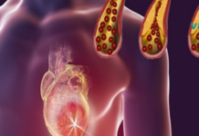 გაიწმინდეთ არტერიები ამ 10 საკვების დახმარებით! მაშ რაღატომ გვჭირდება აბები, თუ ეს პროდუქტები არსებობს?!..