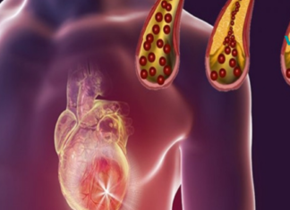 გაიწმინდეთ არტერიები ამ 10 საკვების დახმარებით! მაშ რაღატომ გვჭირდება აბები, თუ ეს პროდუქტები არსებობს?!..