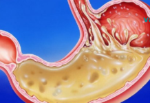 ეს მდგომარეობა თითქმის ყველა მეორე ადამიანს აწუხებს!! საუკეთესო საშინაო საშუალებები კუჭში მჟავა გარემოს კონტროლისთვის