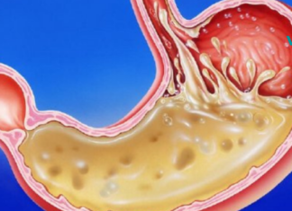 ეს მდგომარეობა თითქმის ყველა მეორე ადამიანს აწუხებს!! საუკეთესო საშინაო საშუალებები კუჭში მჟავა გარემოს კონტროლისთვის