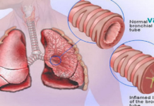 სწრაფად მოიშორეთ გულმკერდის ნახველი და ლორწო ამ ეფექტური ბუნებრივი საშუალებების დახმარებით!!