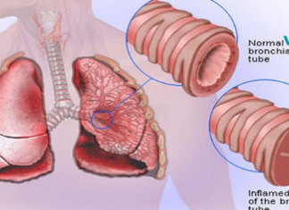 სწრაფად მოიშორეთ გულმკერდის ნახველი და ლორწო ამ ეფექტური ბუნებრივი საშუალებების დახმარებით!!