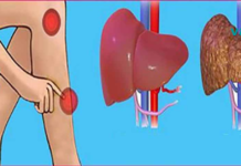 10 გამაფრთხილებელი ნიშანი იმისა, რომ თქვენი ღვიძლი გამართულად არ ფუნქციონირებს. ფრთხილად! ეს ტოქსინები გროვდება თქვენს ცხიმოვან ქსოვილებში!