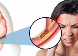 ინსულტის 5 ადრეული ნიშანი, რომელიც ყველა შემთხვევაში უნდა იცოდეთ! აუცილებლად დაიმახსოვრეთ ეს!