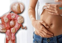 ეს რეცეპტი დაიცავს თქვენს ორგანიზმს ცისტებისგან, ორგანიზმისთვის ზიანის მიყენების გარეშე. არ დაგეზაროთ და მოამზადეთ ეს სამკურნალო სასმელი დღესვე!