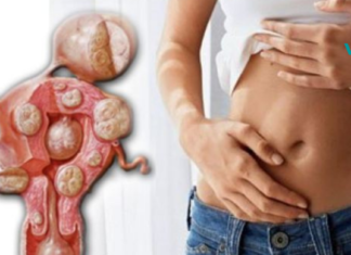 ეს რეცეპტი დაიცავს თქვენს ორგანიზმს ცისტებისგან, ორგანიზმისთვის ზიანის მიყენების გარეშე. არ დაგეზაროთ და მოამზადეთ ეს სამკურნალო სასმელი დღესვე!