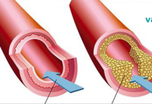 დაბინდული არტერიების ფარული ნიშნები და საუკეთესო საკვები მისი პრევენციისთვის!