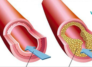 დაბინდული არტერიების ფარული ნიშნები და საუკეთესო საკვები მისი პრევენციისთვის!