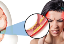 ინსულტის 5 ადრეული ნიშანი, რომელიც უნდა იცოდეთ!! აუცილებლად წაიკითხეთ!