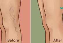 5 საშინაო საშუალება, რომელიც შეგიძლიათ გამოიყენოთ ფეხებიდან ვარიკოზული ვენების მოსაშორებლად!