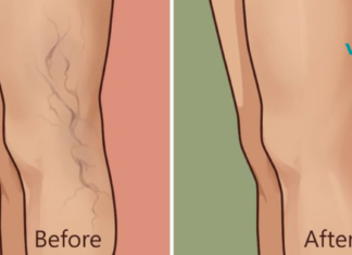5 საშინაო საშუალება, რომელიც შეგიძლიათ გამოიყენოთ ფეხებიდან ვარიკოზული ვენების მოსაშორებლად!