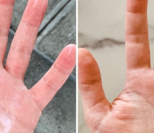 ეს უნდა წაიკითხოთ: როგორ ხდება ბუნებრივი გზით ოფლიანობის თავიდან აცილება!