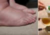 ეს ხალხური საშუალებები დაგავიწყებენ ფეხების შეშუპების პრობლემას! დღესვე სცადეთ და თავადვე დარწმუნდებით ამაში..