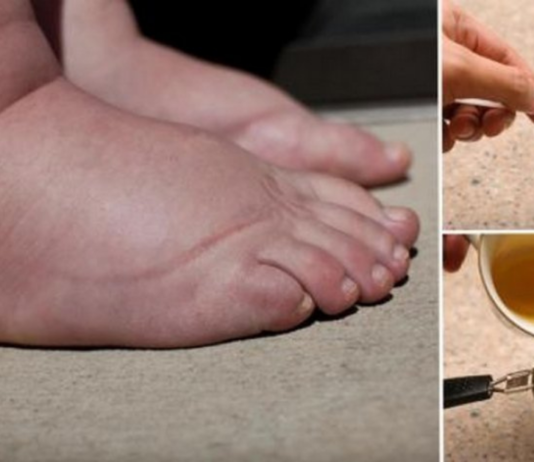 ეს ხალხური საშუალებები დაგავიწყებენ ფეხების შეშუპების პრობლემას! დღესვე სცადეთ და თავადვე დარწმუნდებით ამაში..