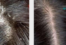 ეს ნატურალური საშუალებები ქერტლს რამდენიმე დღეში მოგაშორებენ. უბრალოდ სცადეთ!