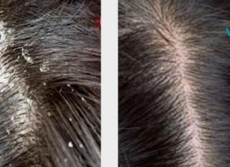 ეს ნატურალური საშუალებები ქერტლს რამდენიმე დღეში მოგაშორებენ. უბრალოდ სცადეთ!