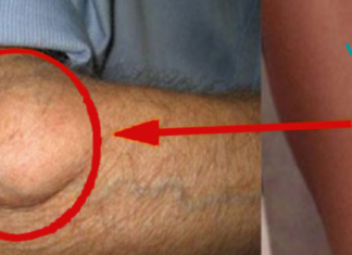 თქვენ არ გჭირდებათ ოპერაციის გაკეთება, ამ მეთოდით შეგიძლიათ მოიცილოთ თითქმის ყველა სახის კისტა!!