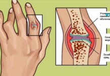 წლების გამოცდილი მკურნალობა რევმატოიდული ართრიტისა და ანთებისთვის!!