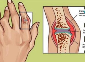 წლების გამოცდილი მკურნალობა რევმატოიდული ართრიტისა და ანთებისთვის!!