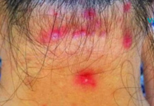 ფიბრომიალგიის სიმპტომები – ნებისმიერმა ადამიანმა, რომელსაც აქვს კუნთების ტკივილი, უნდა წაიკითხოს ეს!