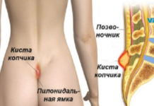 რა არის პილონიდალური დაავადება და მისი მკურნალობის მეთოდები!!